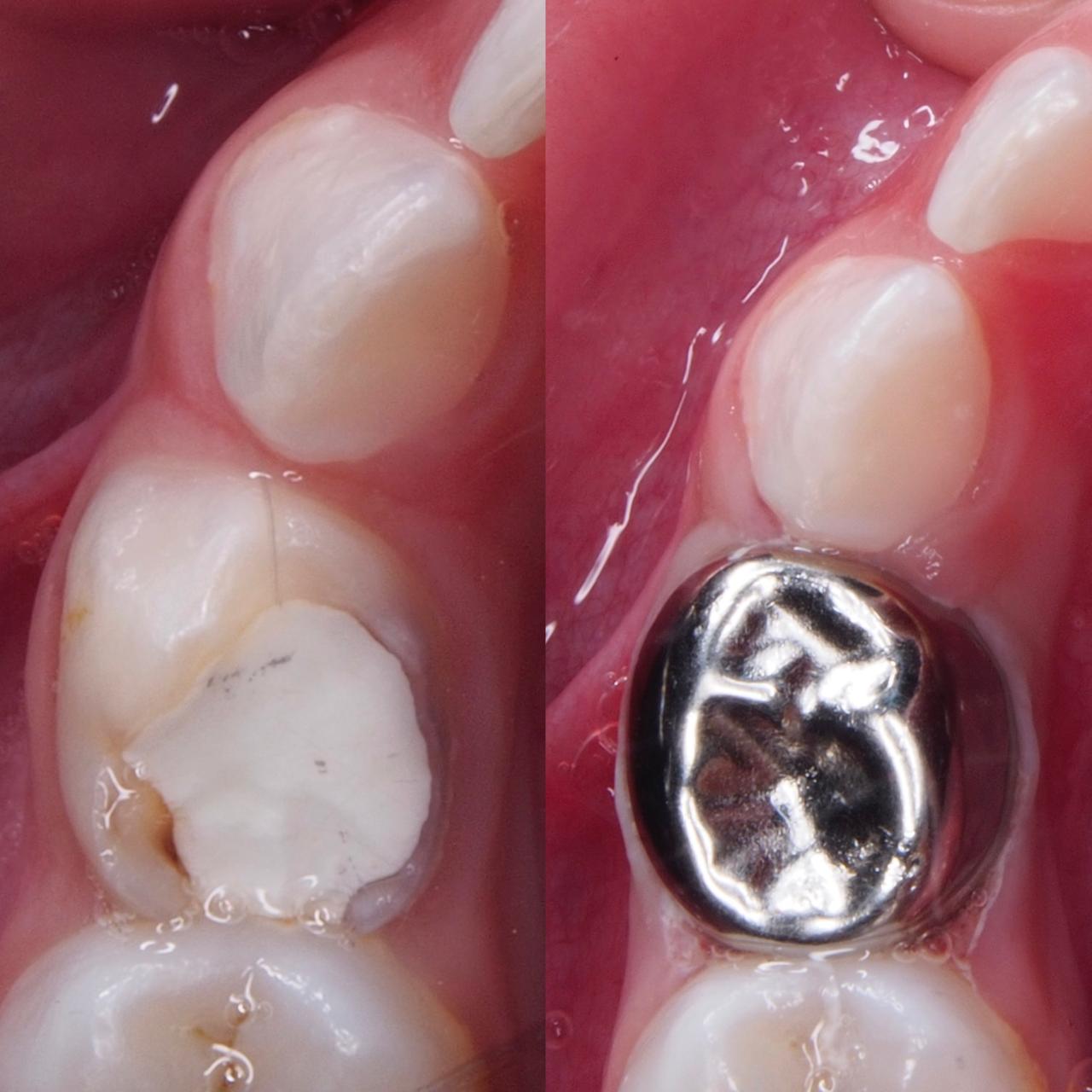 Stainless Steel Crown