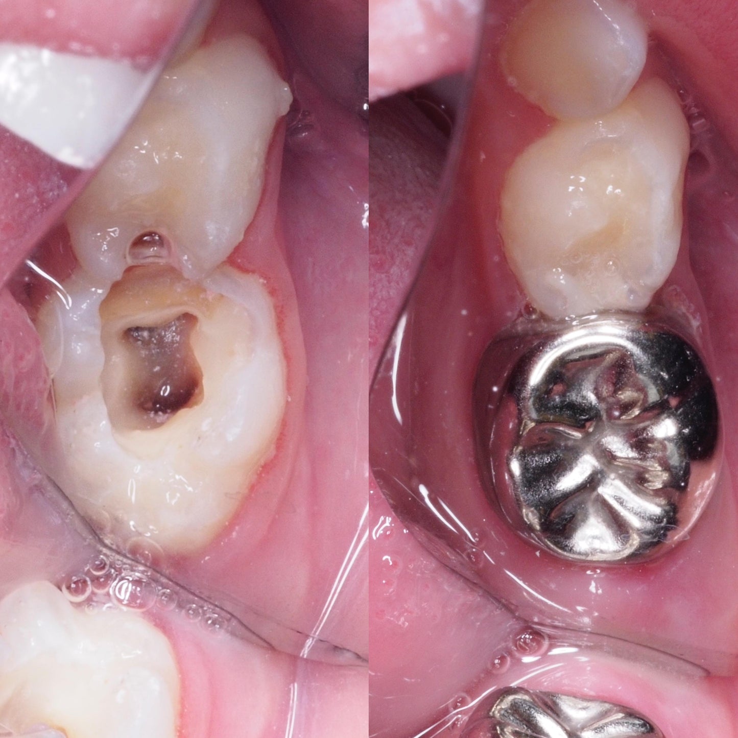 Kids Root Canal Treatment (Perawatan Saluran Akar Anak)