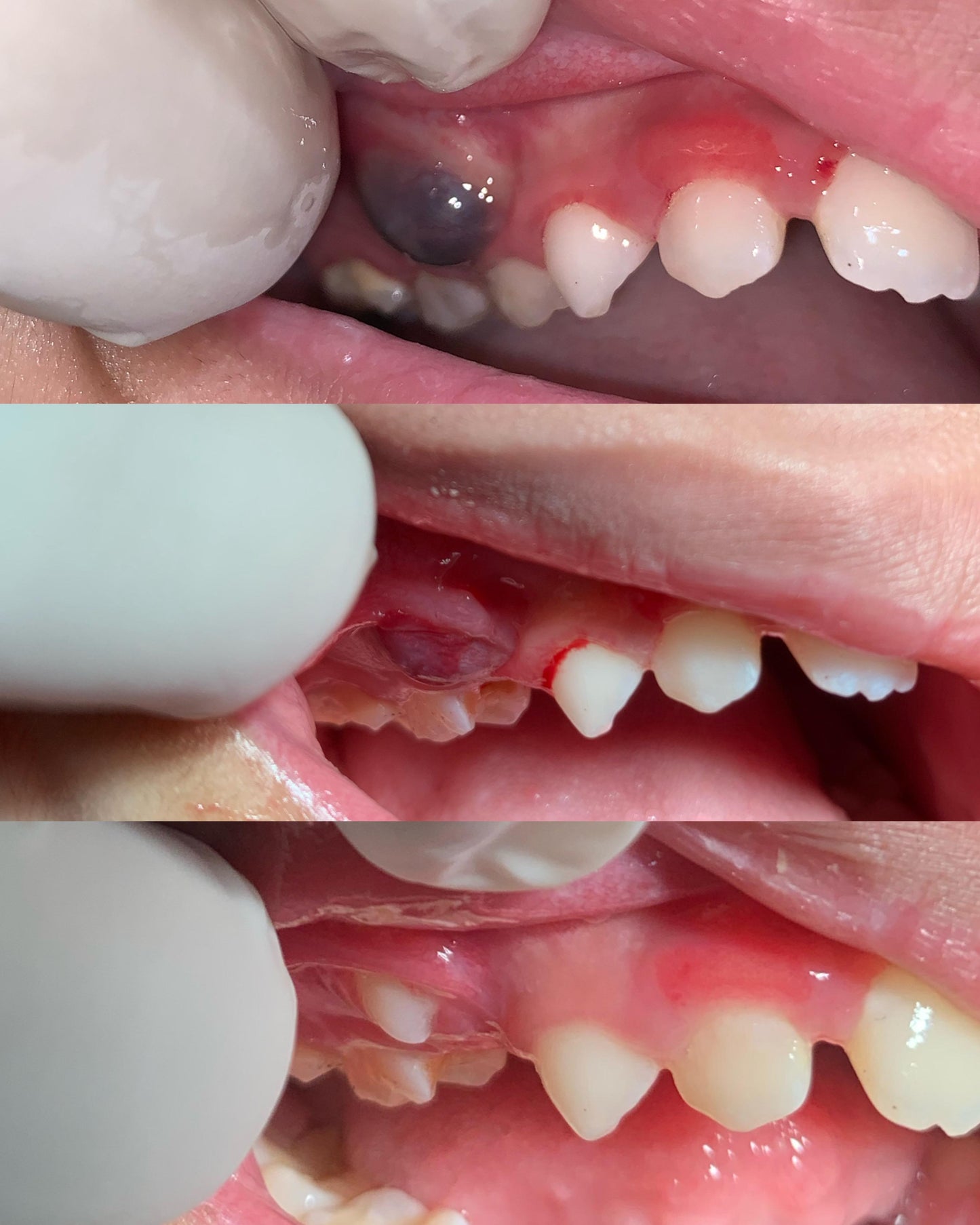 Kids Dental Surgery (Operasi Gigi Anak)