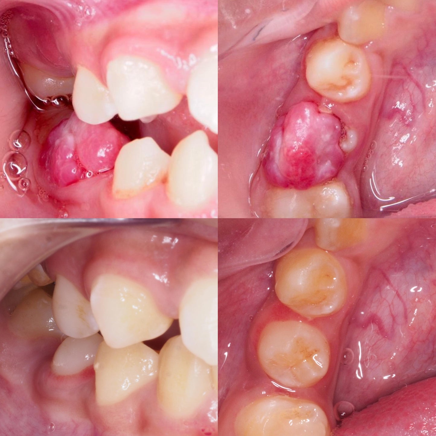 Kids Dental Surgery (Operasi Gigi Anak)