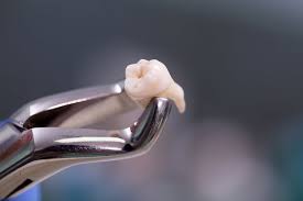 Tooth Extraction (Pencabutan Gigi)
