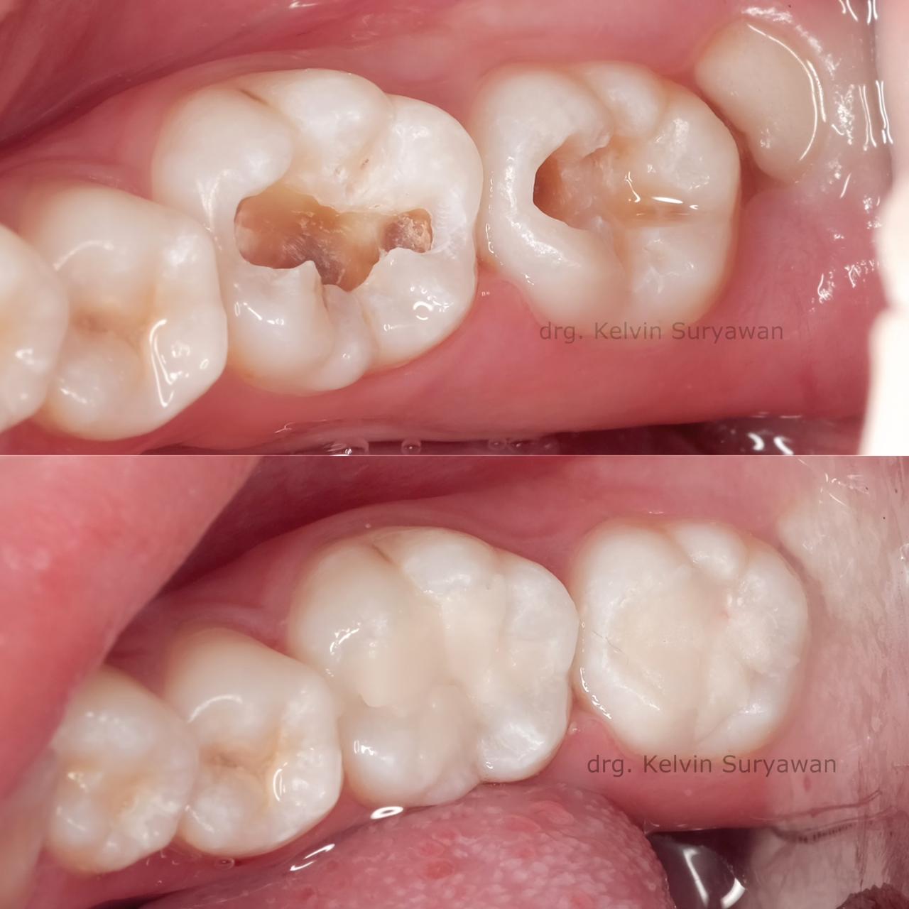 Tooth Filling (Tambal Gigi)