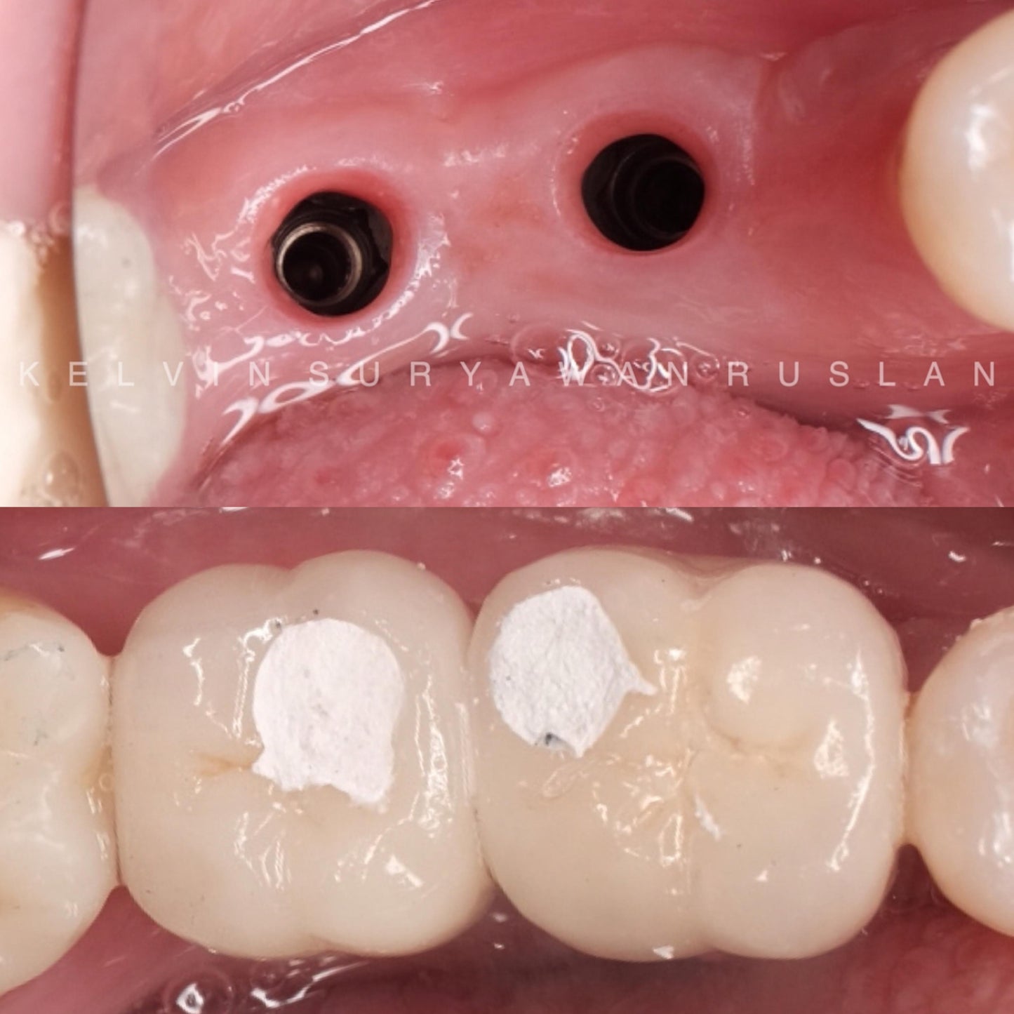 Implant