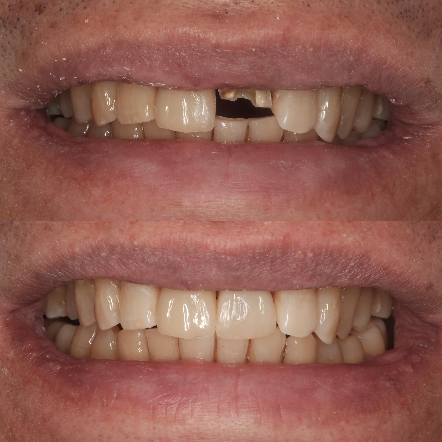 Smile Make Over
