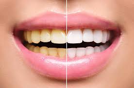 Whitening