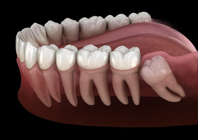 Wisdom Teeth Surgery (Operasi Gigi Bungsu)